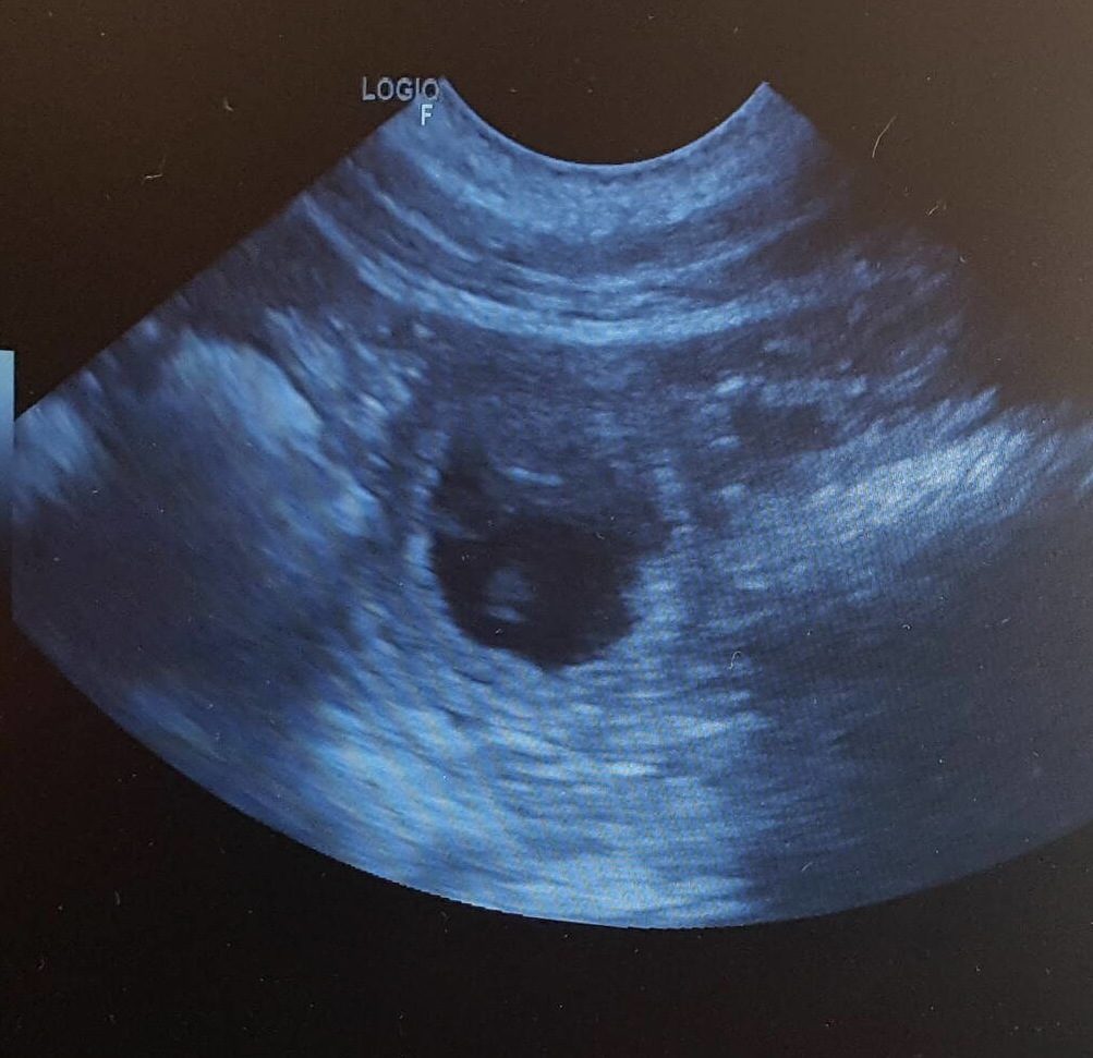 January 2019-11 Carbon's ultrasound.jpg